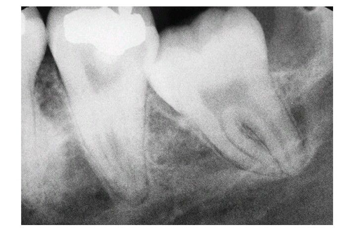 Wide periodontal ligament space