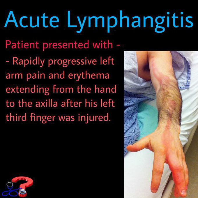 Acute Lymphangitis