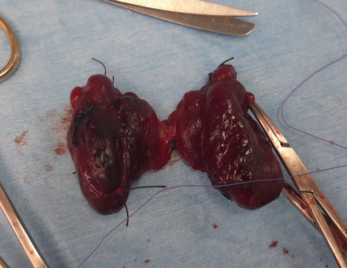Total Thyroidectomy