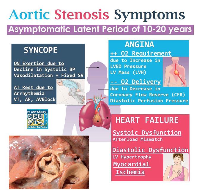 Aortic stenosis