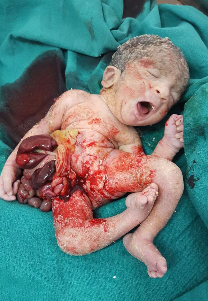 Gastroschisis