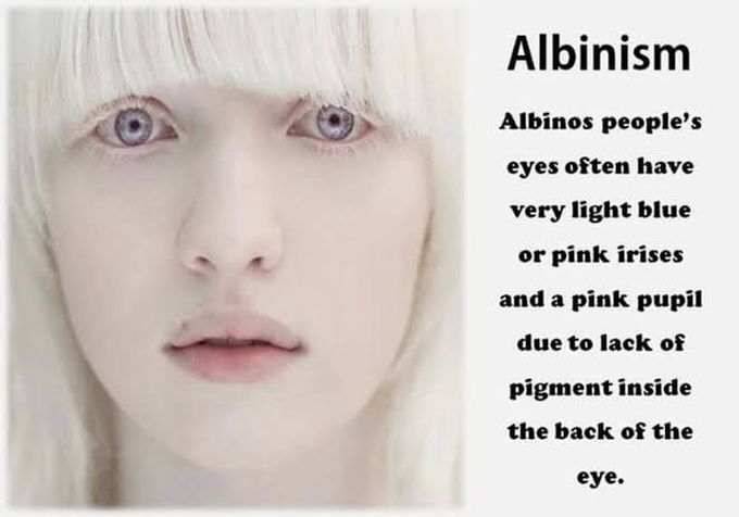 Albinism