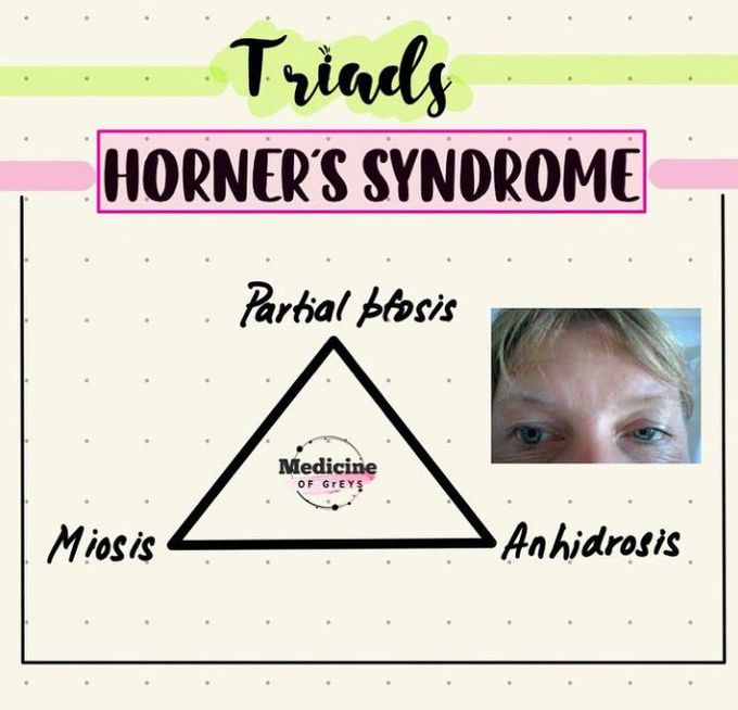 Horner's syndrome