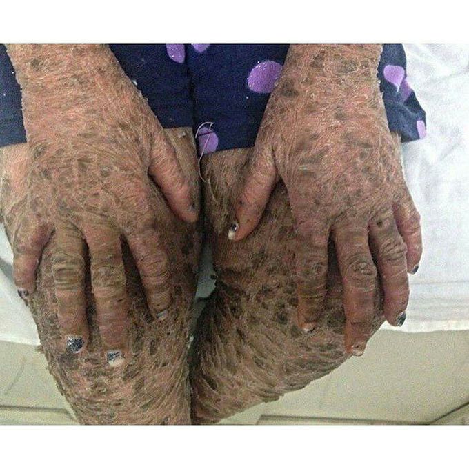 Ichthyosis.
