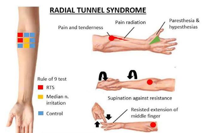 These are the signs of Radial tunnel syndrome