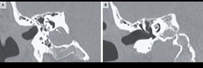 Pneumolabyrinth and Pneumocochlea