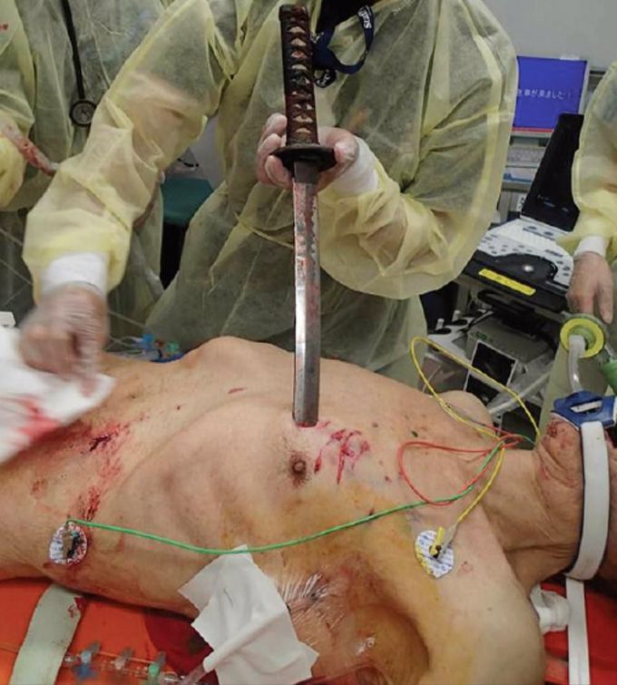 Case of a penetrating injury caused by a Japanese sword (katana)