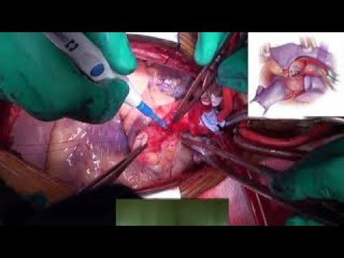 Unroofing of Left Main Coronary Artery with Trans-septal Course