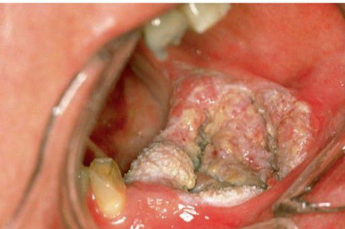 Verrucous carcinoma (mandibular vestibule)