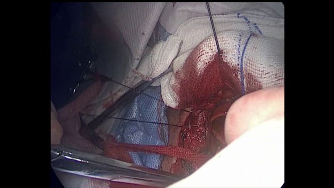 Nonintubated Tracheal Resection