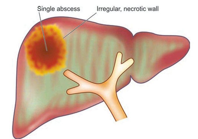 Amoebic abscess