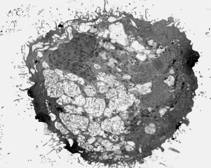 Scientists discover chemical which can kill glioblastoma cells
