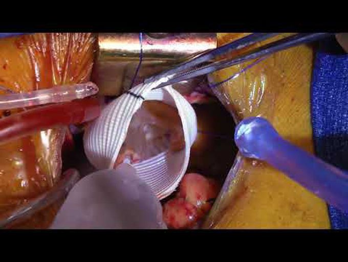 Minimally Invasive Valve-Sparing Aortic Root Replacement