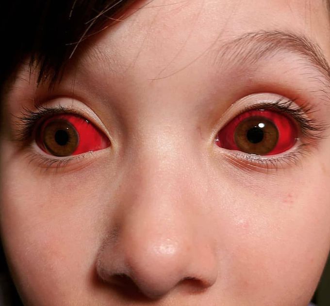 Interesting case of a child having red eyes due to subconjuctival hemorrhage.  