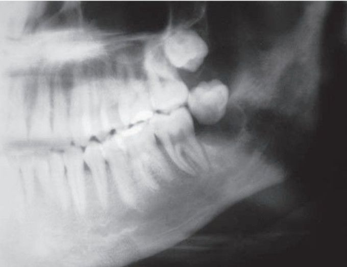 Postradiation chondrosarcoma