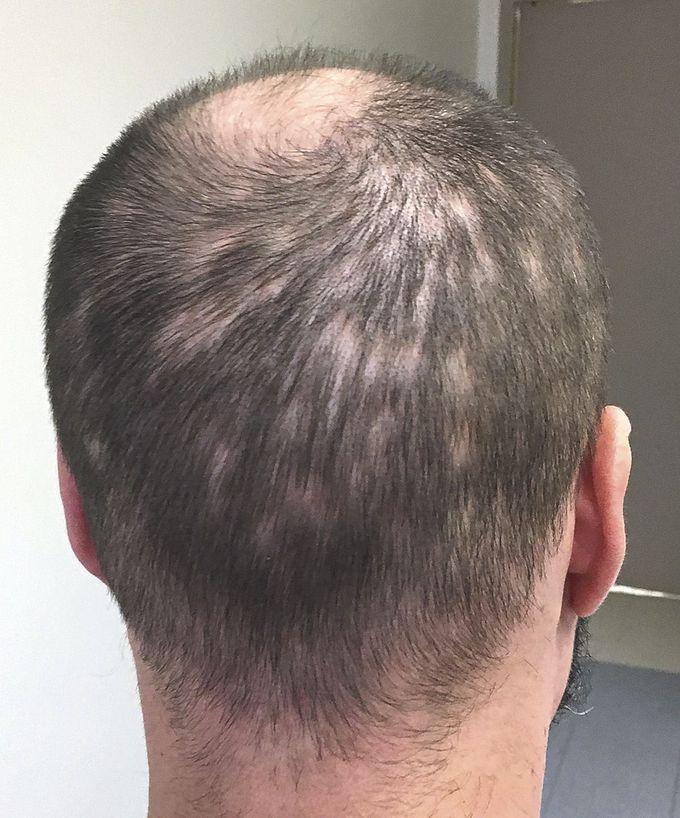 Syphilitic Alopecia