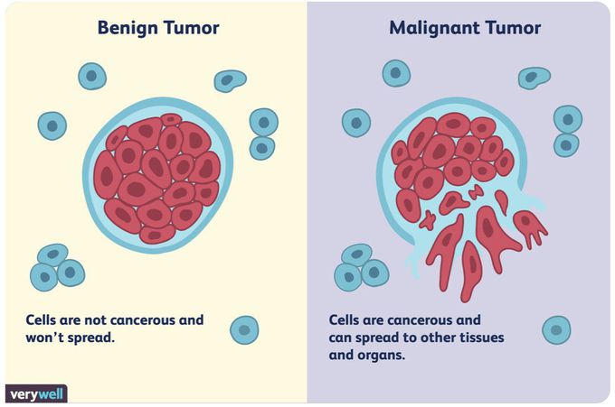 Basic difference between Benign and Malignant Tumor