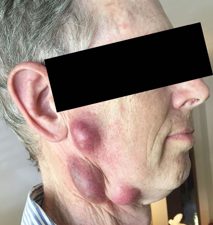 Glandular Tularemia
