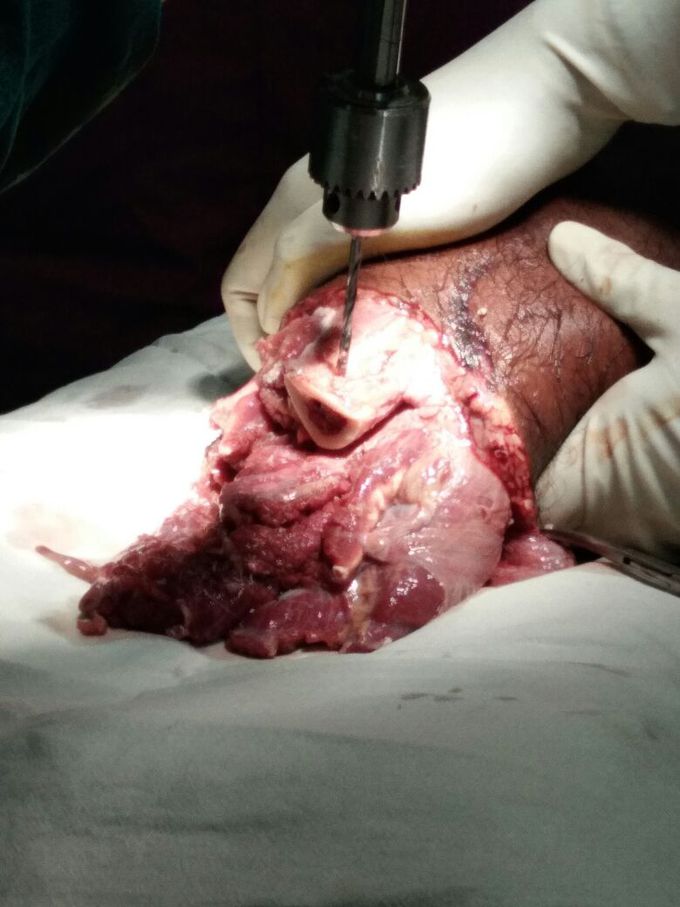 Same patient # surgery half complete