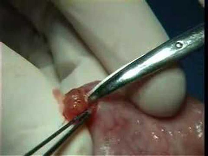 Surgical removal of Mucocele