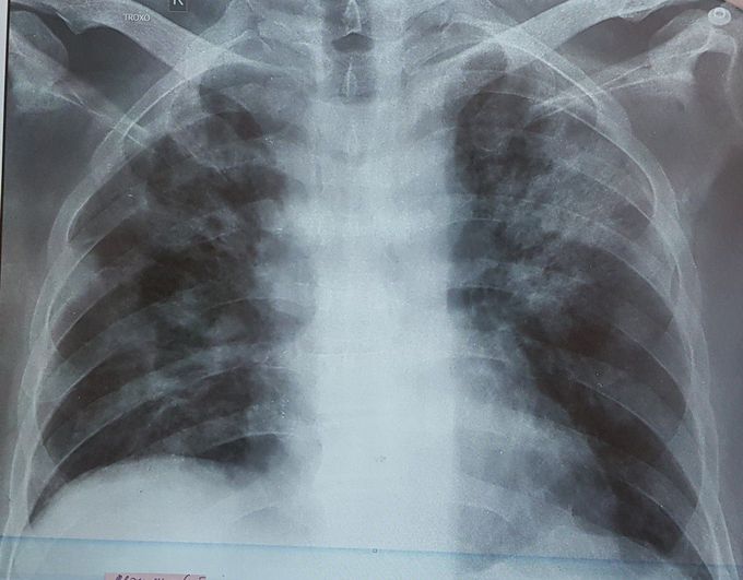 COVID-19 DURING TREATMENT