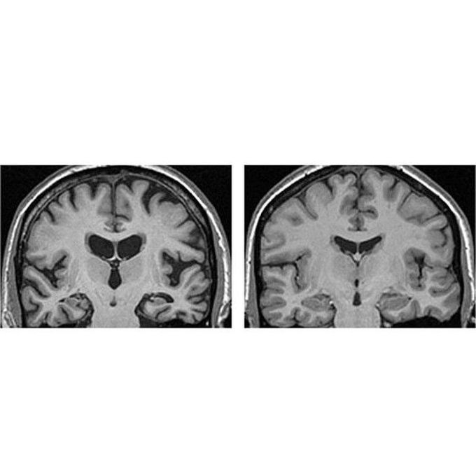 Comparison of a normal human brain MRI (right) and an MRI (left) taken from a patient with a well-known disease - Alzheimer's disease!
