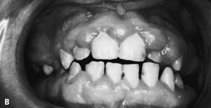 Gingival enlargement