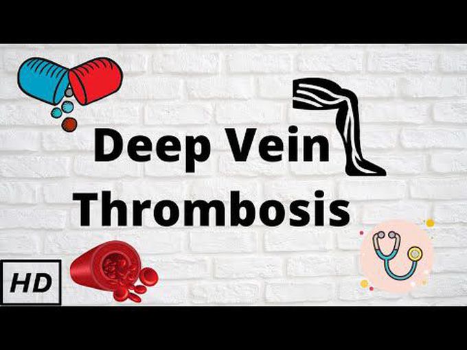 Deep vein thrombosis-3D model