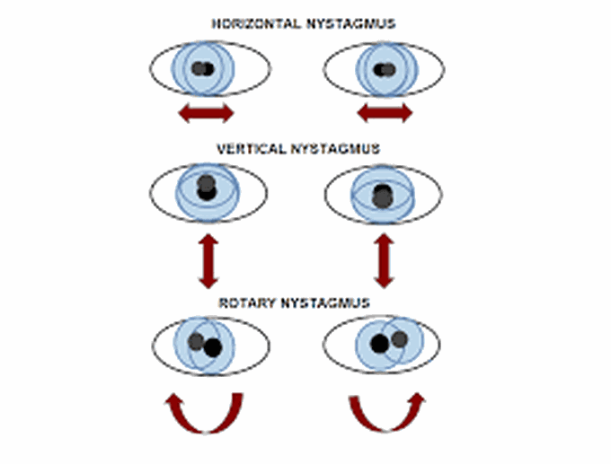 Causes of nystagmus