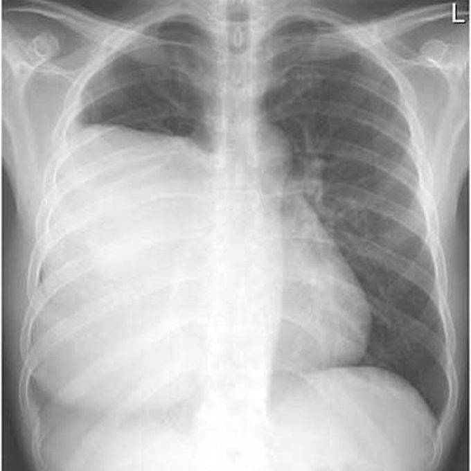 Thymoma
