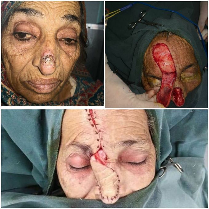 Basal Cell Carcinoma