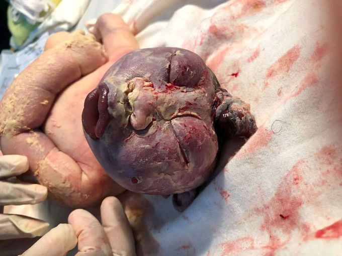 Anencephaly