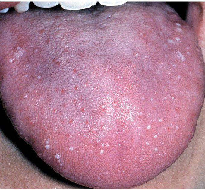 Transient Lingual Papillitis.