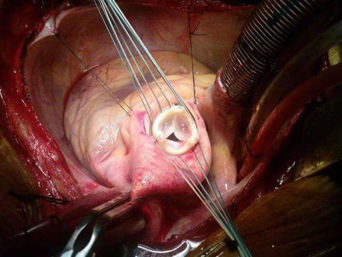 Heart valve replacement