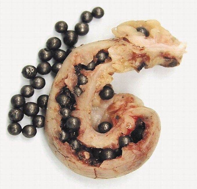 Pellets in the Appendix