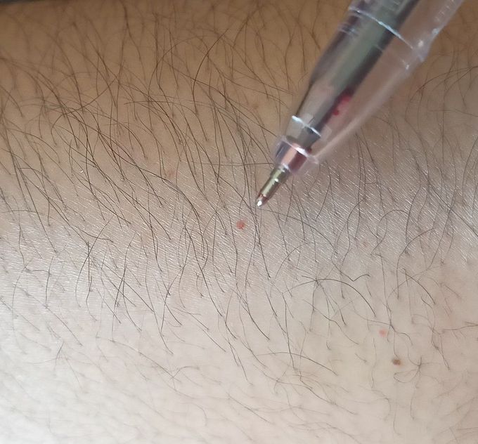 Dermatology