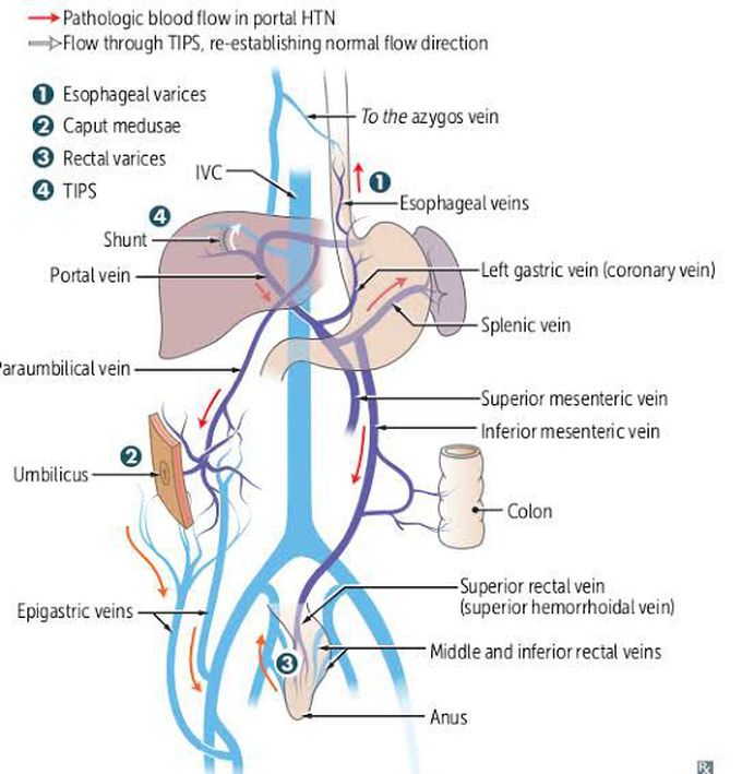 Porto-systemic Anastomosis