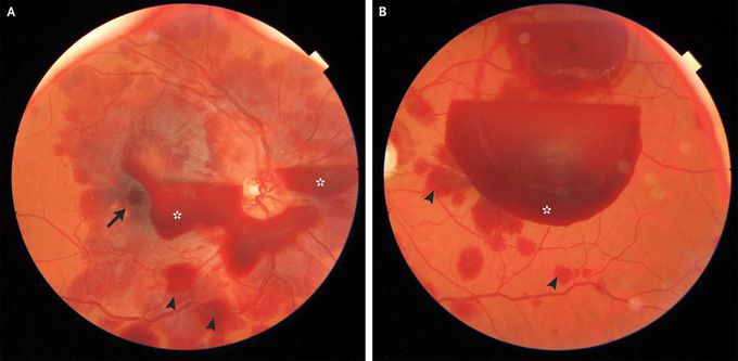 Terson’s Syndrome