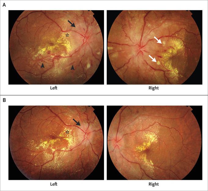 Reversible Loss of Vision in Malignant Hypertension