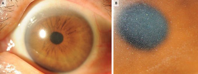 Corneal Crystalline Deposits in a Patient with Multiple Myeloma