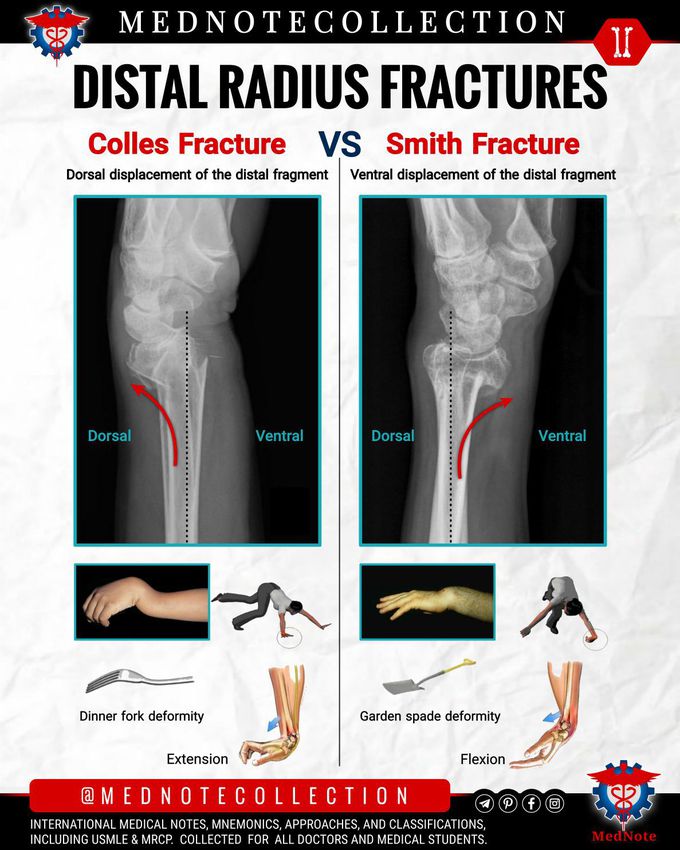 Distal Radius fractures