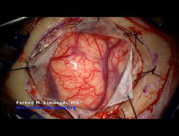 Brain surgery:  Parietal craniotomy for resection of metastatic brain tumor.
