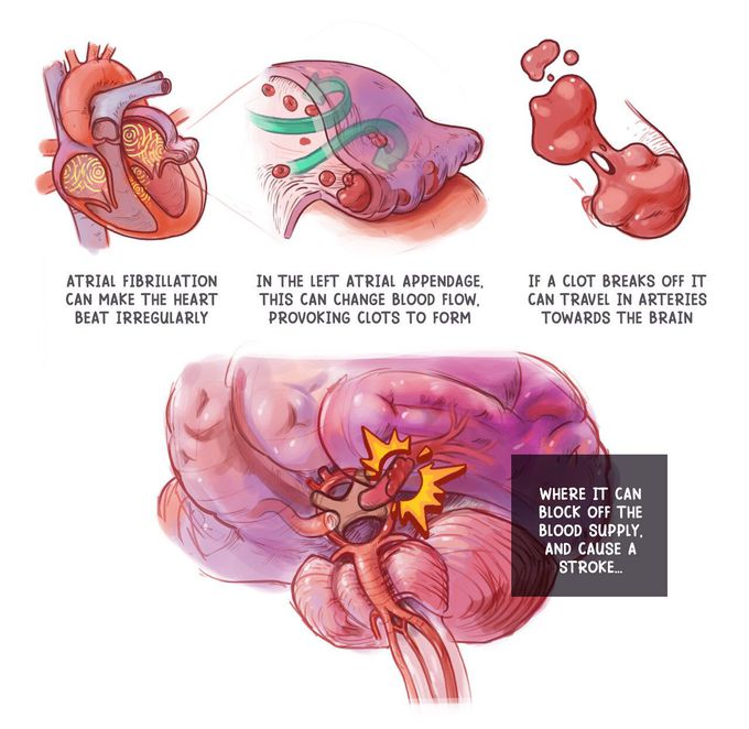 How AFib can cause Stroke?