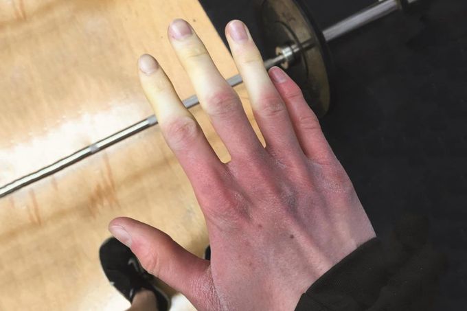 Raynaud’s Phenomenon