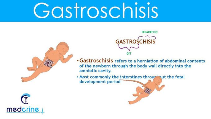 Gastroschisis-Embryology