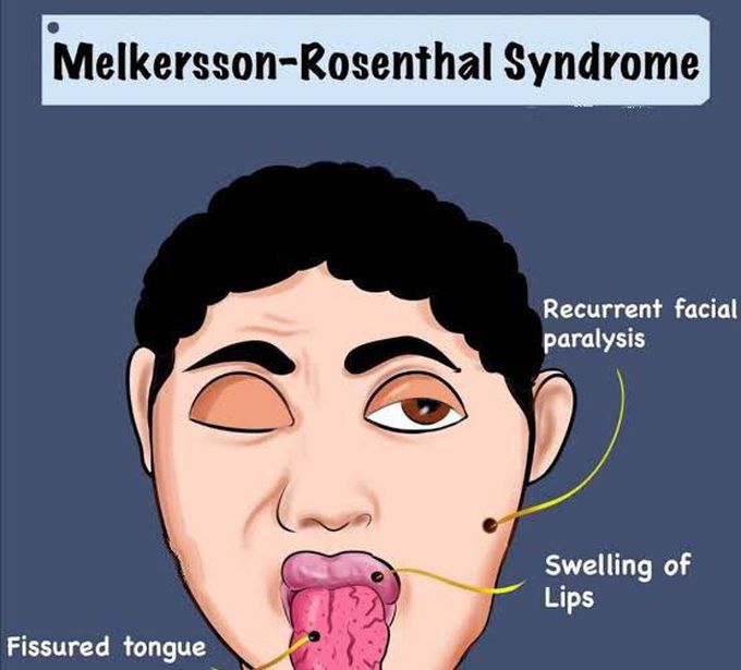 These are the symptoms of Melkersson Rosenthal syndrome