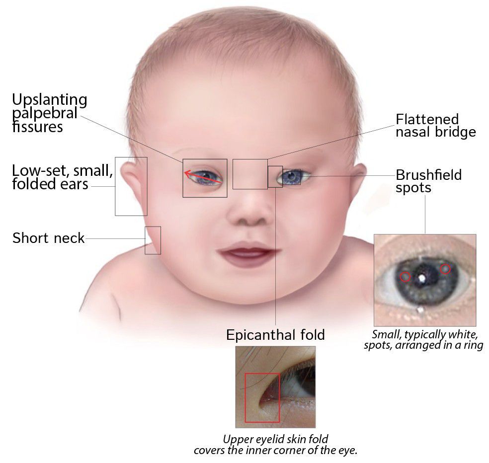 Key Facial Characteristics of Down Syndrome MEDizzy