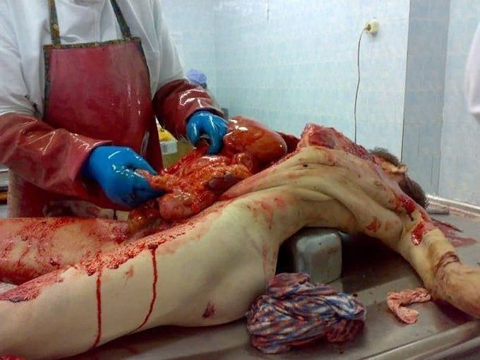Autopsy