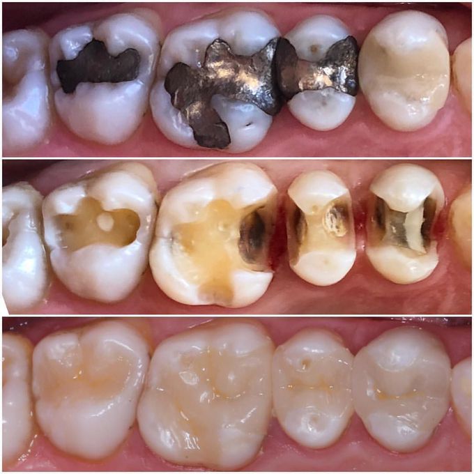 Exchanging amalgams with porcelain fillings.