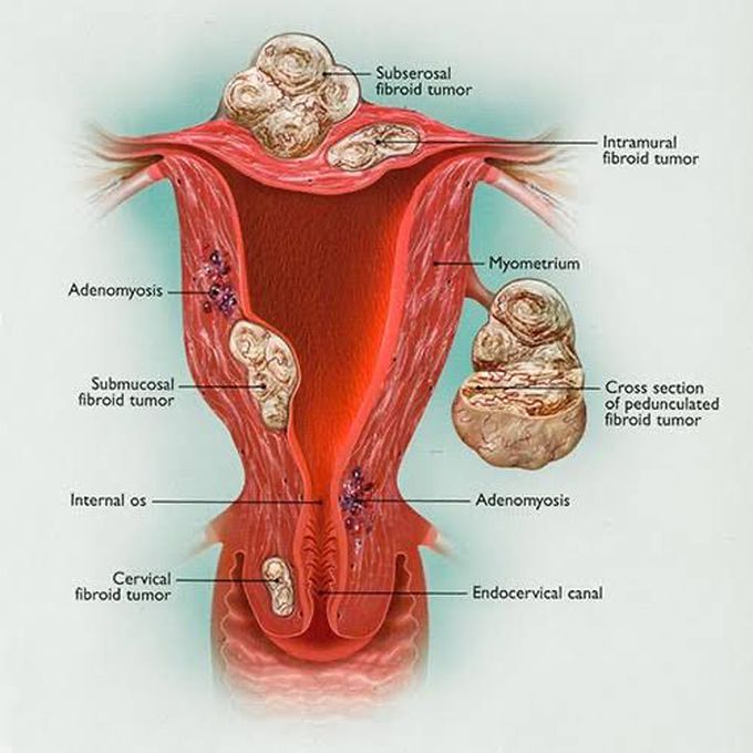 Fibroids or Leiomyomas
